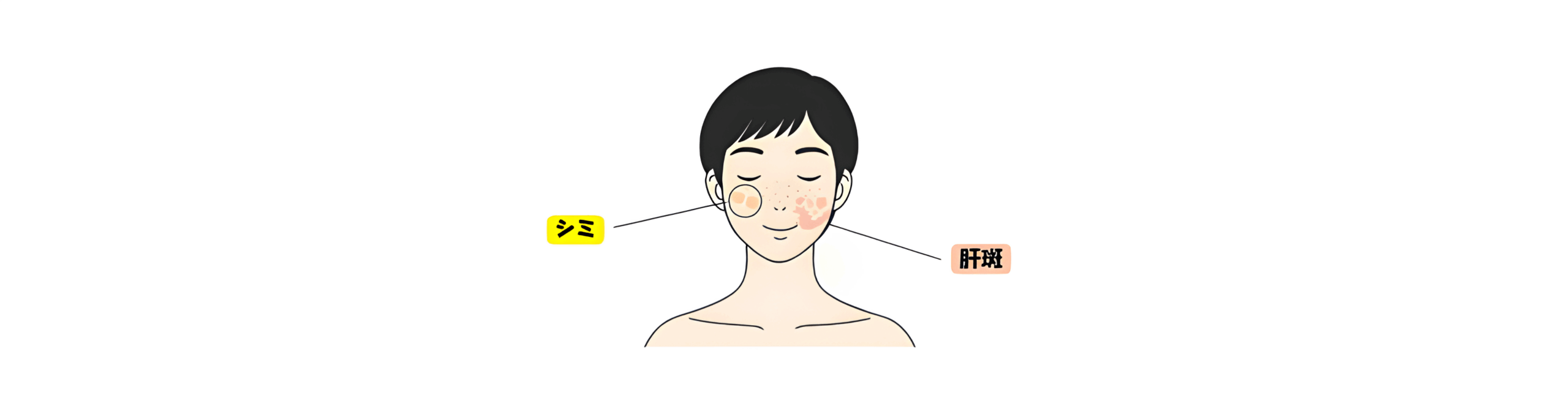 シミ・肝斑の違い
